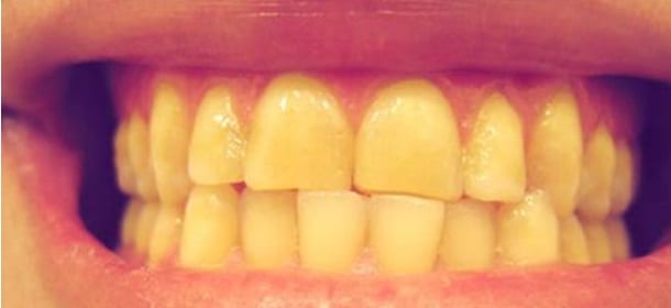 Denti gialli, sei rimedi casalinghi per sbiancarli