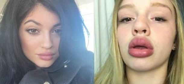 Kylie Jenner, labbra "sottovuoto": la pericolosa moda diffusa fra i giovani