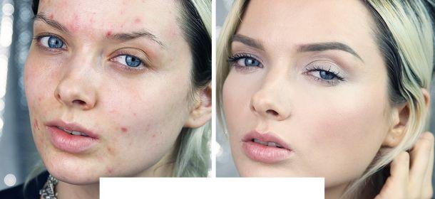 Acne, come coprirla: la blogger americana Em Ford mostra il make-up perfetto [TUTORIAL]