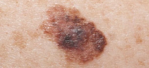 Melanoma: contando i nei sul braccio destro si calcola il rischio