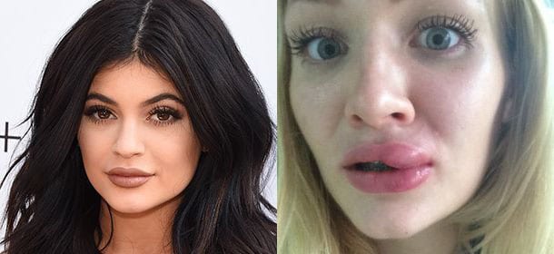 Voleva le labbra come Kylie Jenner e ha comprato un coupon: ora è piena di verruche