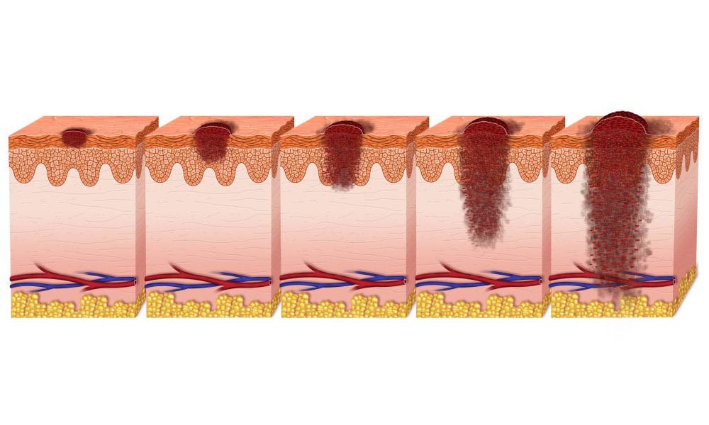 Melanoma, scoperta l'origine delle metastasi: così si potranno bloccare