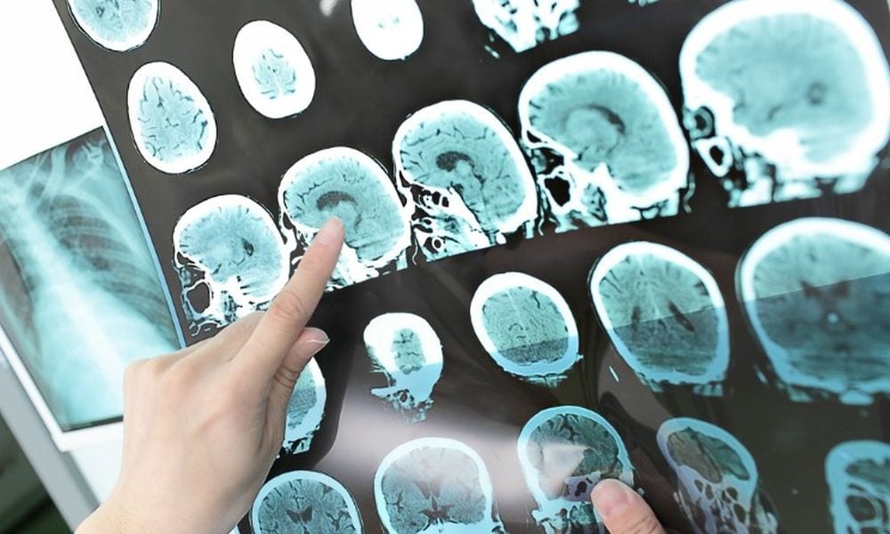 Iniezione di staminali contro l'ictus: i pazienti recuperano i danni al cervello