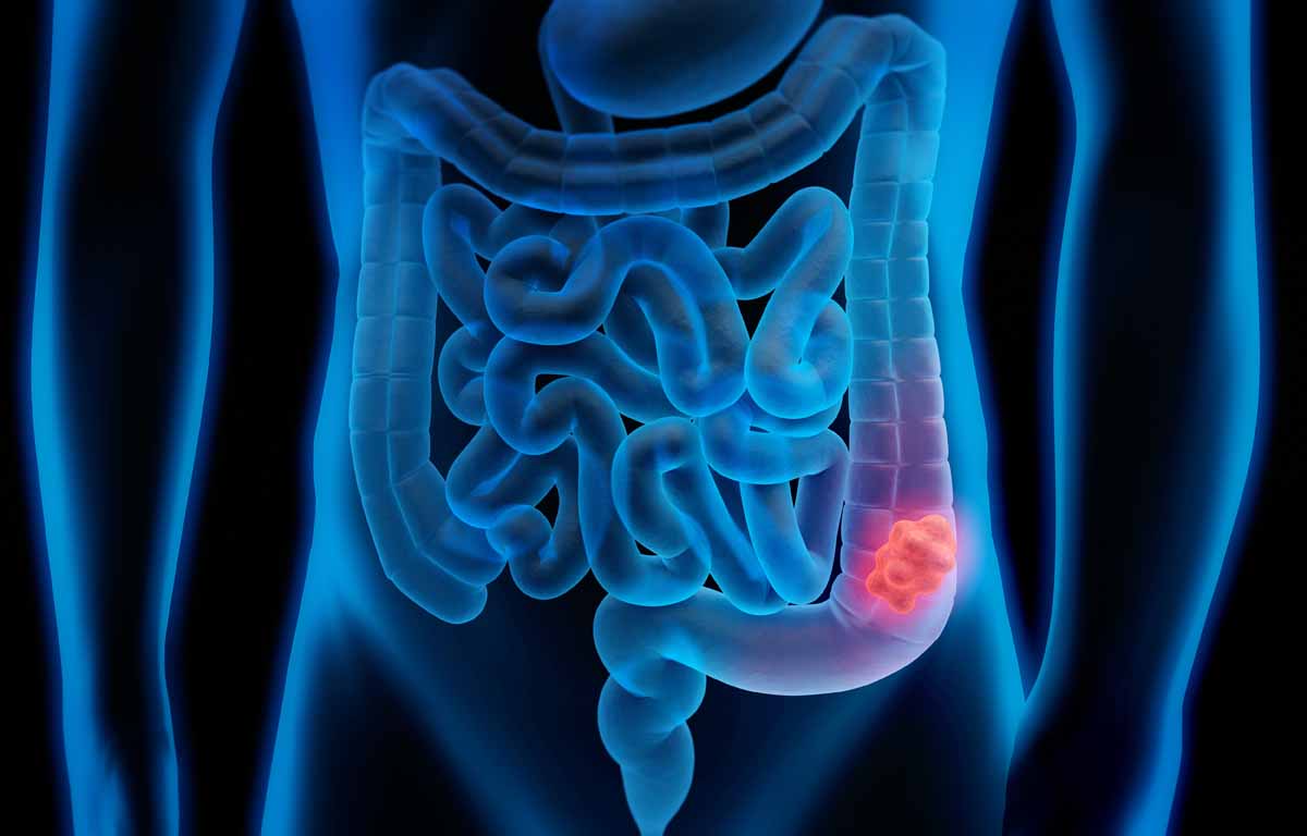 Tumore colon sintomi: come riconoscerlo e fare prevenzione